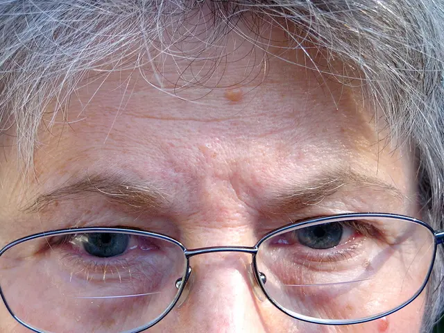 Research Reveals Potential of Contact Lenses in Checking Myopia Advancement