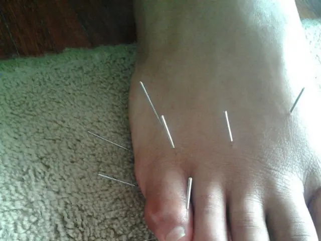 Lifesaving Intervention of Endovascular Stent Grafting for Rare Superior Mesenteric Vein Erosion in...