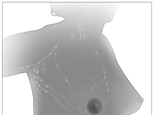 The image shows a woman's breast with a cancerous tumor in the center, surrounded by a white...